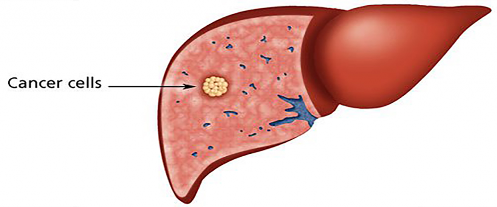 how-when-and-why-does-liver-gets-affected-what-are-its-symptoms