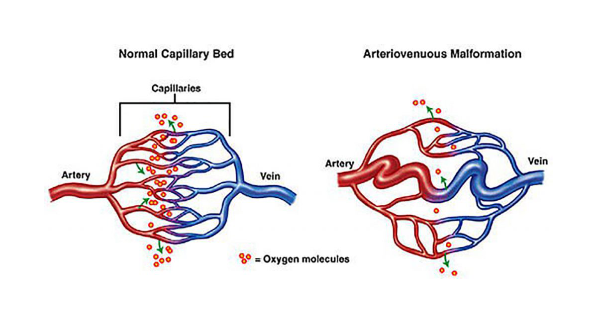 Артериовенозный шунт. Артериовенозный шунт головного мозга. Артериовенозный порок. Лимфатическая мальформация. Капиллярная мальформация.