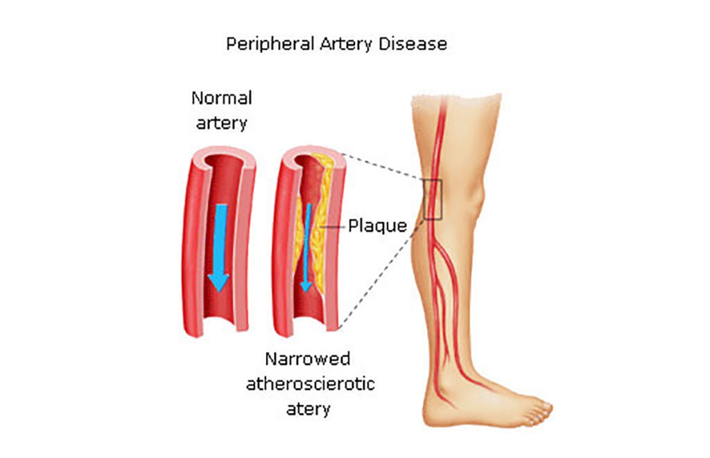 peripheral-arterial-disease-people-diabetes