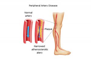 63de21f3-peripheral-arterial-disease-people-diabetes-300x193  