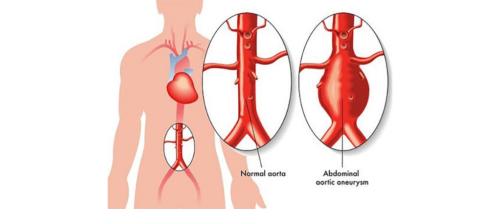 endovascular-repair-abdominal-aortic-aneurysm-safe
