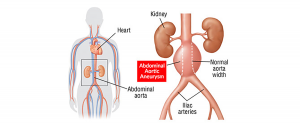 21615de7-abdominal-aortic-aneurysm-bubble-burst-300x126  