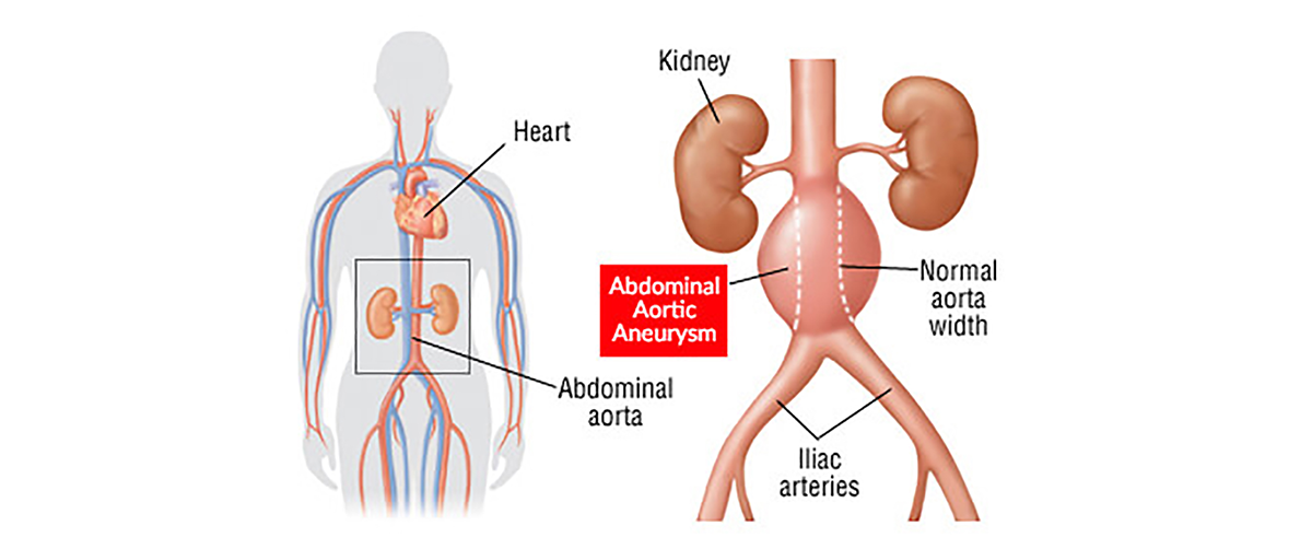 how-long-to-fully-recover-from-aortic-valve-replacement-best-design-idea