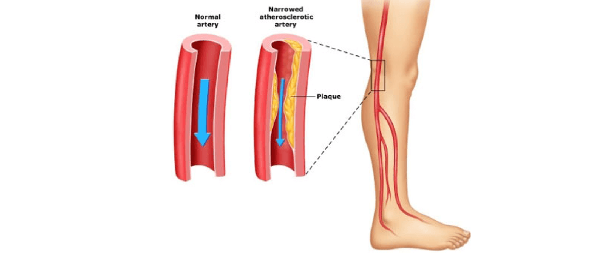 Peripheral Arterial Disease Vs Critical Limb Ischemia