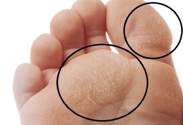 diabetic-foot-infection-symptoms-causes-and-treatment