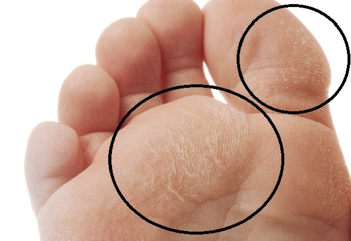 cellulitis bottom of foot