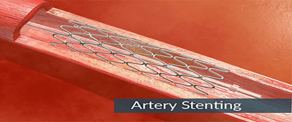 benefits-of-endovascular-repair-with-a-stent-graft