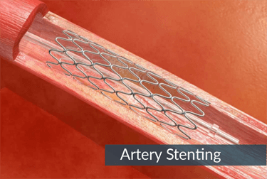 Artery-Stenting 