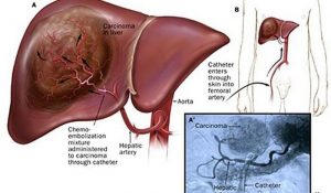 Chemoembolization-in-the-Management-of-Liver-Tumours--300x175  
