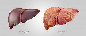 1302183c-how-when-and-why-does-liver-gets-affected-what-are-its-symptoms-300x126  