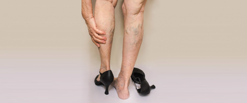 get-to-know-whats-triggering-varicose-veins