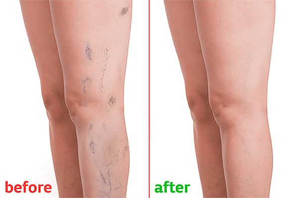 Varicose Vein Removal With EVLT