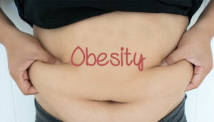 Can-Obesity-cause-varicose-veins-300x171  