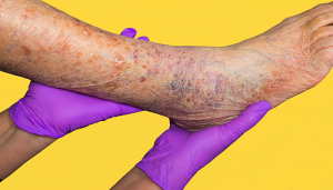 Varicose-Eczema-300x171  