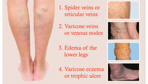 478471fe-stages-of-varicose-veins-disease-300x171  