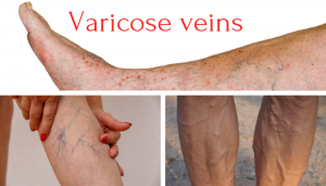 cc4ed14b-varicose-veins-1-300x171  
