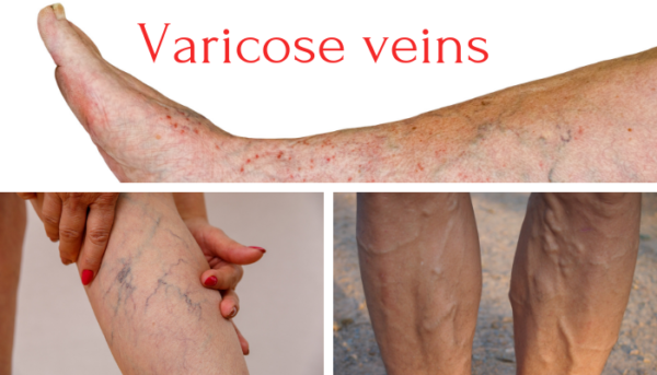 Varicose Veins In Legs Dr Abhilash Sandhyala Vascular Surgeon