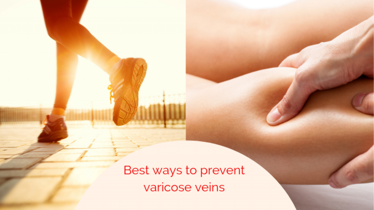 Does exercise really help to reduce Varicose Veins?