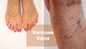 Varicose-Veins-4-300x171  