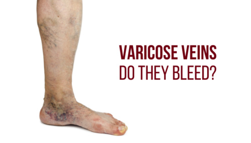 Burst Varicose Veins Bruise Dr Abhilash 