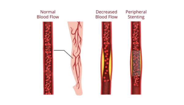 Peripheral Stenting Hyderabad - Peripheral Vascular Treatment Telangana, AP