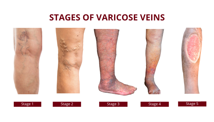 ruler panic according to What are Varicose Veins? ,Symptoms, Causes & Treatment, Procedures
