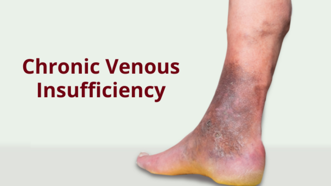 Chronic Venous Insufficiency: Causes, Symptoms and Treatment