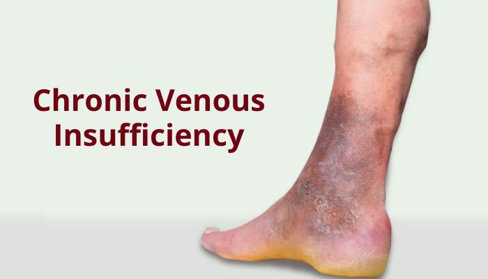 Chronic Venous Insufficiency Guide