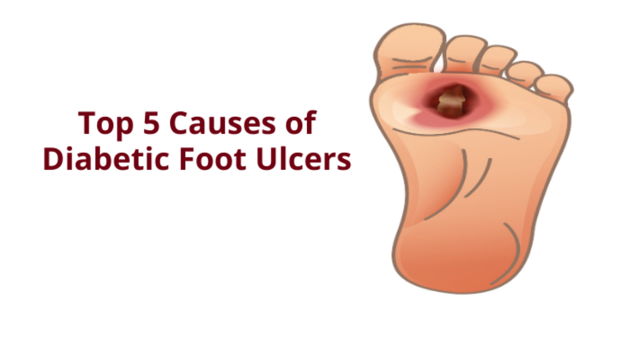 What Causes a Diabetic Ulcer on Your Foot? - footsurgeon