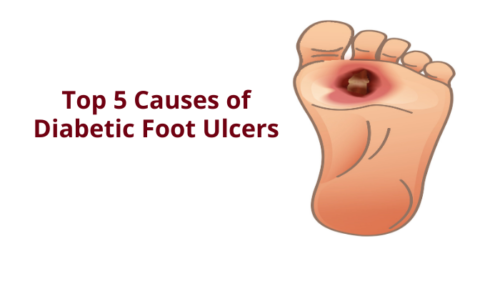 6-things-to-know-when-treating-venous-leg-ulcers-medline