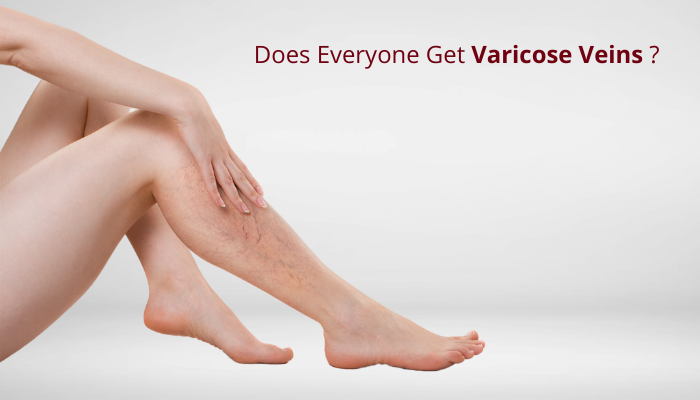 everyone get varicose veins