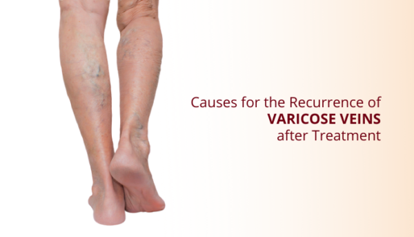 Causes For The Recurrence Of Varicose Veins After Treatment Dr Abhilash 