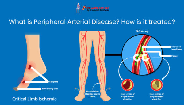 What Is Peripheral Arterial Disease? How Is It Treated? | Dr Abhilash