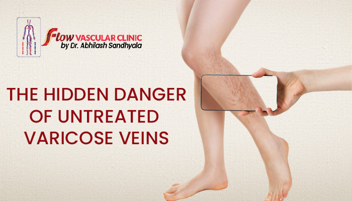 The-hidden-danger-of-untreated-varicose-veins-1 