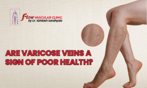 Are-varicose-veins-a-sign-of-poor-health-1-300x180 