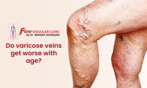 Do Varicose Veins Get Worse With Age Dr Abhilash