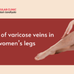 What are the best exercises to prevent Varicose Veins