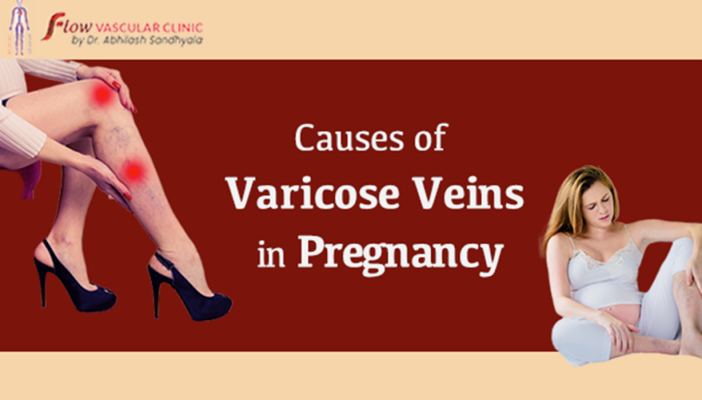 Causes of varicose veins in pregnancy