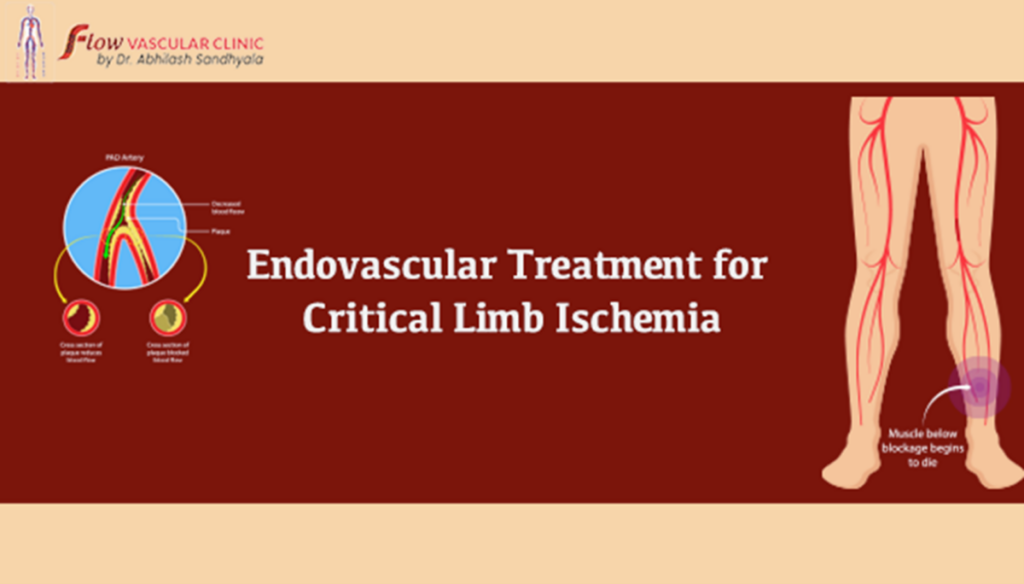 Endovascular Treatment for Critical Limb Ischemia