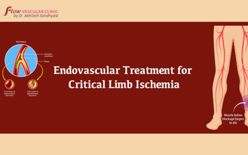 Endovascular-Treatment-for-Critical-Limb-Ischemia-800x500 