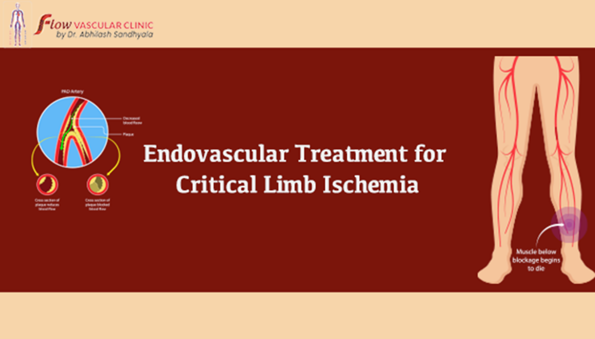 Endovascular-Treatment-for-Critical-Limb-Ischemia  