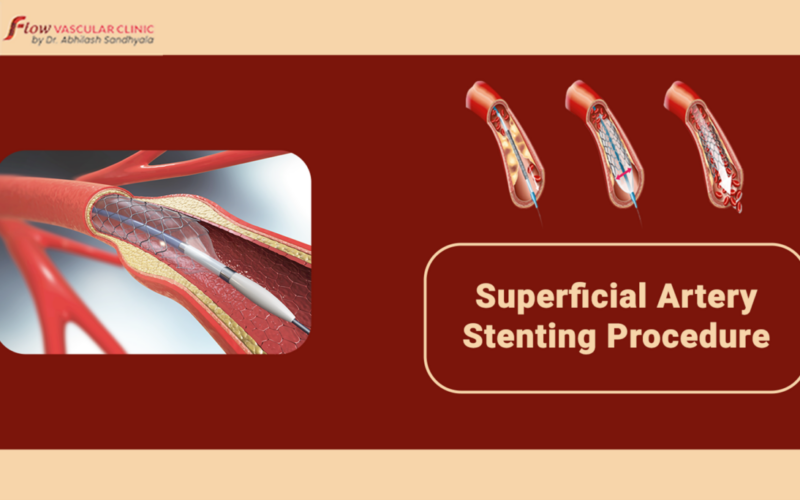 Superficial-artery-stenting-procedure-800x500 