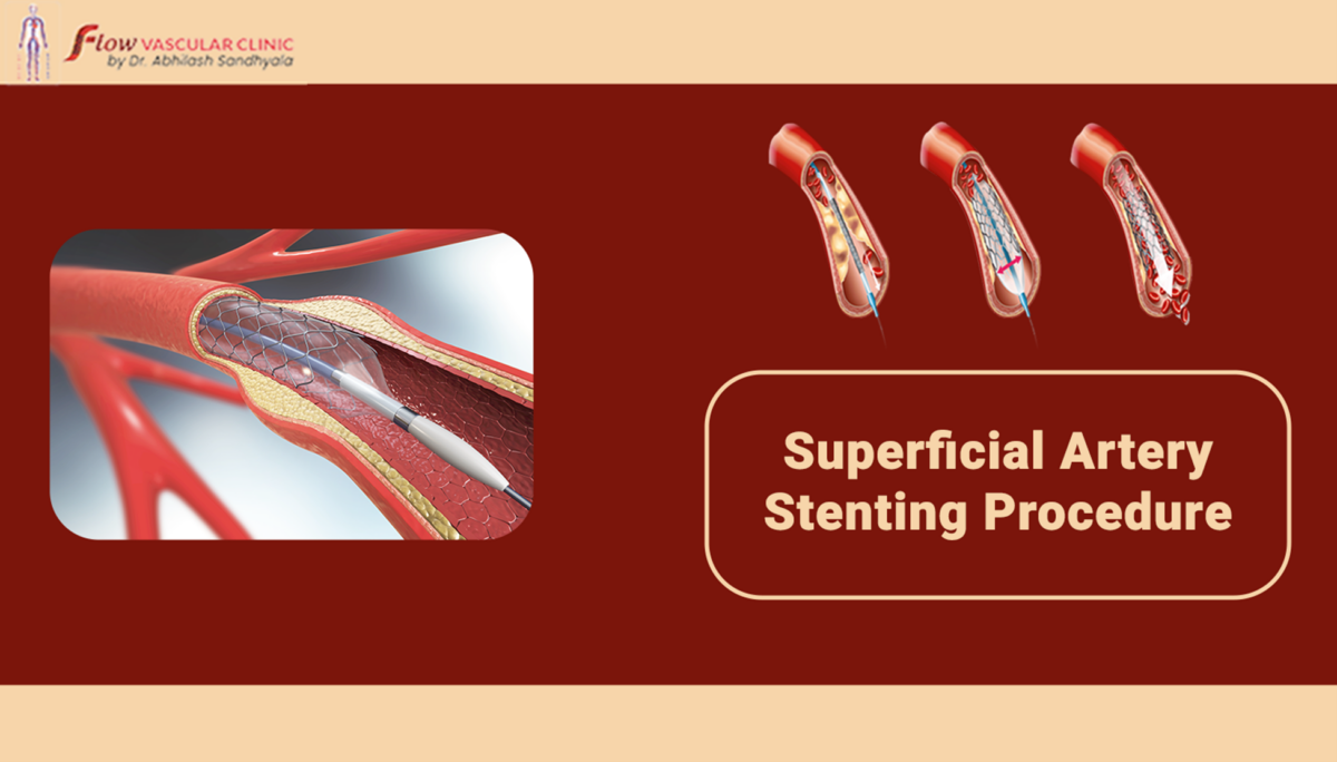 Superficial-artery-stenting-procedure  