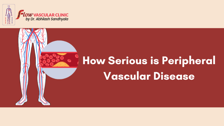 How-Serious-is-Peripheral-Vascular-Disease-1  