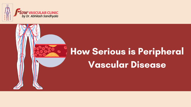 How-Serious-is-Peripheral-Vascular-Disease  