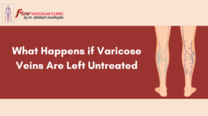What-Happens-if-Varicose-Veins-Are-Left-Untreated-300x168  