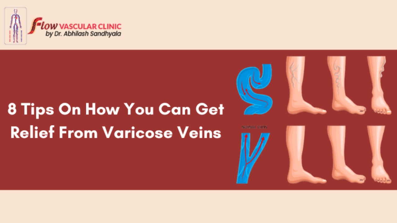 Prevent Varicose Veins: Tips for Healthy Circulation