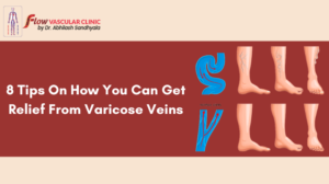 8-Tips-On-How-You-Can-Get-Relief-From-Varicose-Veins-300x168  