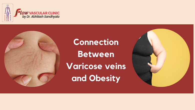 Connection-Between-Varicose-veins-and-Obesity  